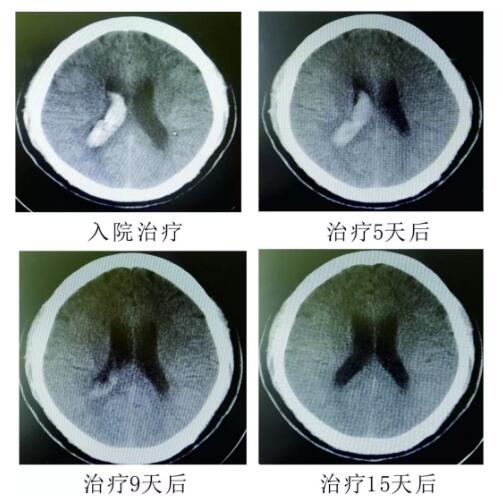 腦出血你不得不引起重視的疾病?。?！