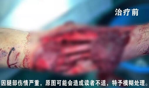 感謝安利醫(yī)院挽救了我的腿，沒有讓我落下殘疾……”