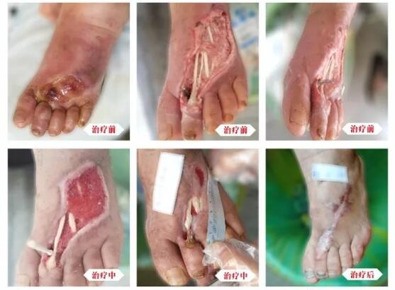 糖尿病并發(fā)癥有多可怕，及時治療糖尿病足避免截肢！