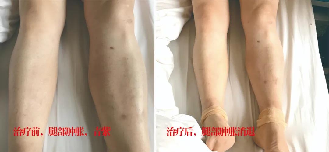 下肢靜脈血栓多年頑疾反復(fù)腫痛——疾病不容等待，早治療，早健康！