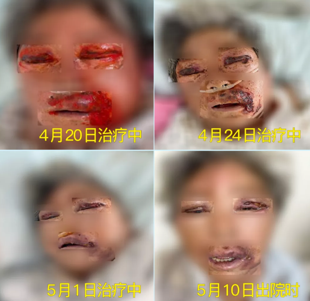 膿毒血癥（急性頜面部蜂窩組織炎）多學(xué)科聯(lián)合會(huì)診，幫助患者成功治愈！