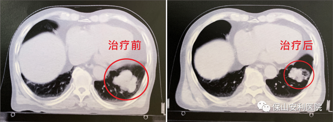 不做手術(shù)，早期肺癌也能根治！
