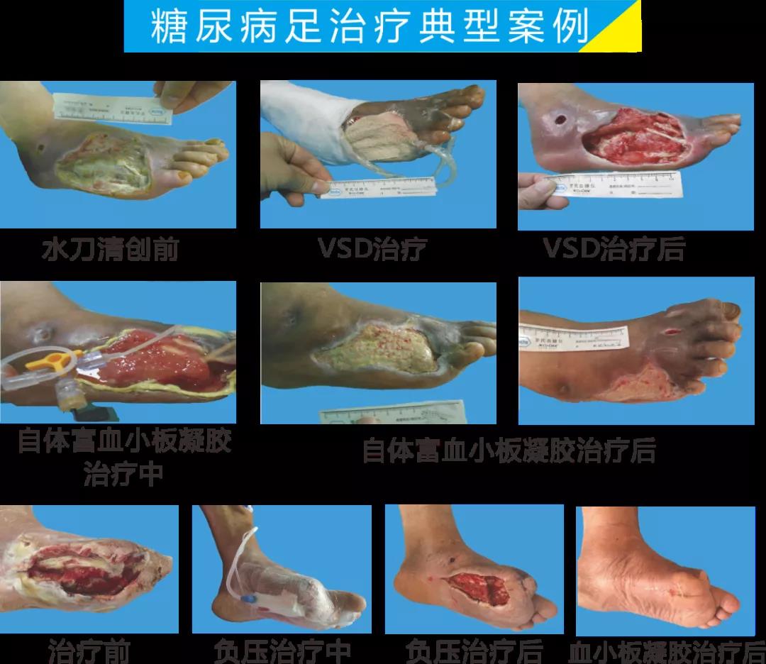 截肢、失明，甚至……，我們要做的是將糖尿病并發(fā)癥遏制在搖籃里！