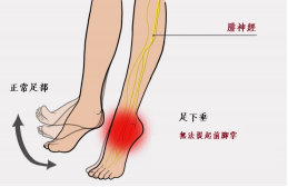 【保山安利醫(yī)院—健康科普】什么是足下垂！你了解嗎？