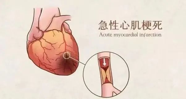 【保山安利醫(yī)院】11月20日“心梗救治日” 時(shí)間就是心肌，時(shí)間就是生命！